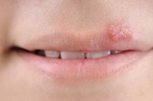 Herpes am Übergang von Haut und Lippe